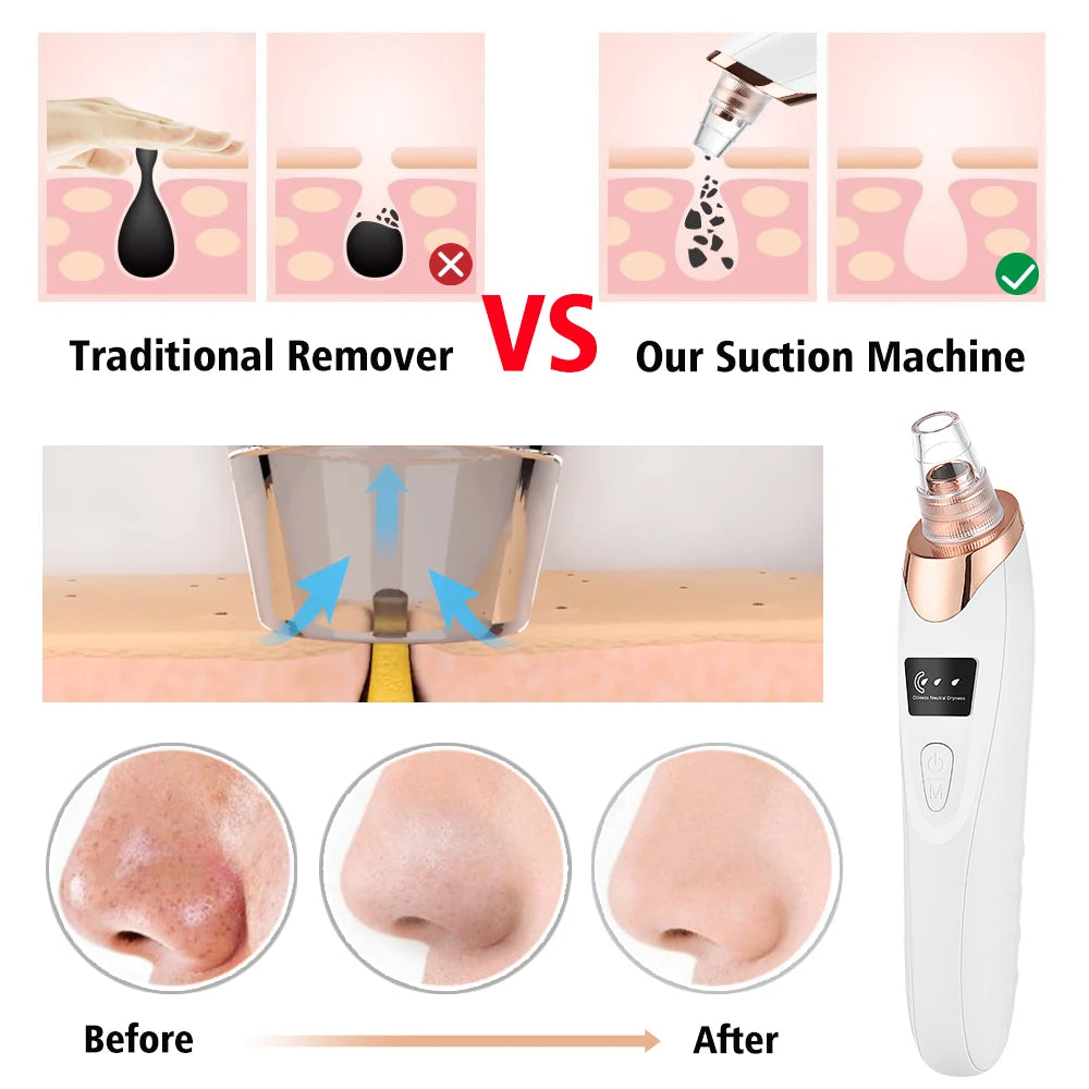 Removedor de Cravos Elétrico 3 Modos - Aspirador Facial para Limpeza Profunda de Poros