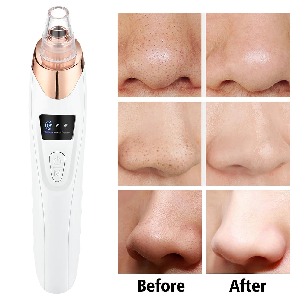 Removedor de Cravos Elétrico 3 Modos - Aspirador Facial para Limpeza Profunda de Poros